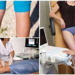 Когда нужно проводить УЗДС вен нижних конечностей?