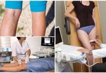 Когда нужно проводить УЗДС вен нижних конечностей?