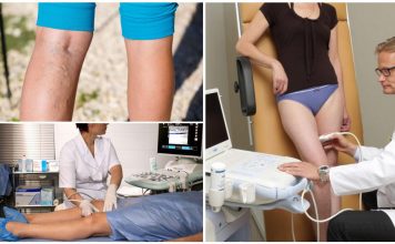 Когда нужно проводить УЗДС вен нижних конечностей?