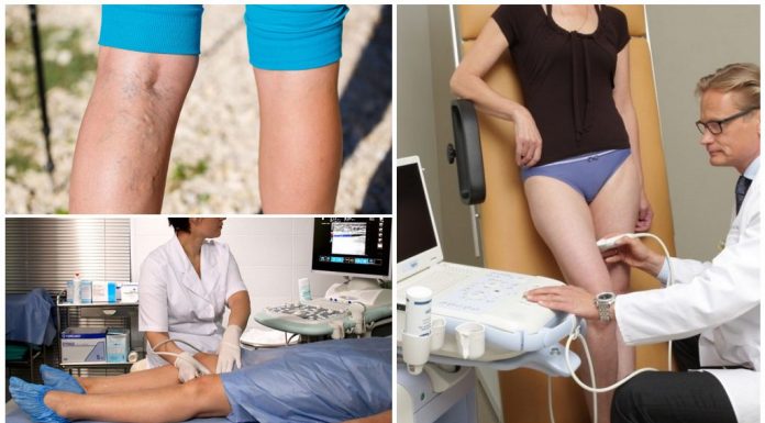 Когда нужно проводить УЗДС вен нижних конечностей?