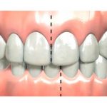 Можно ли исправить прикус у взрослого человека?