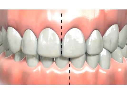 Можно ли исправить прикус у взрослого человека?