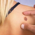 Меланома: самый агрессивный вид рака кожи