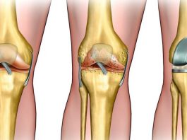 Эндопротезирование: показания и противопоказания к процедуре