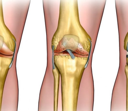Эндопротезирование: показания и противопоказания к процедуре