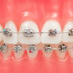 Стоматологические дуги: особенности выбора