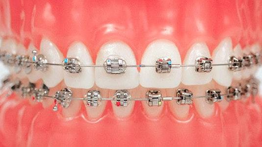Стоматологические дуги: особенности выбора