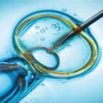 Что такое ИКСИ и как его делают?