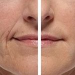 Контурная пластика филлерами: плюсы и минусы