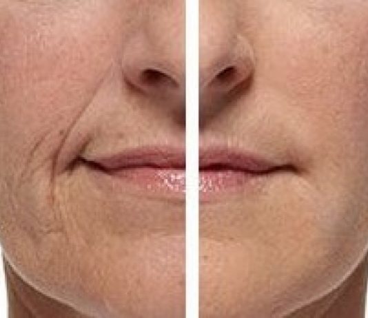 Контурная пластика филлерами: плюсы и минусы