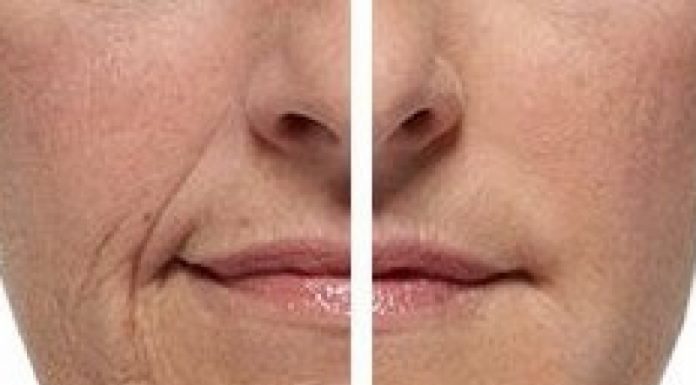 Контурная пластика филлерами: плюсы и минусы