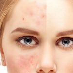 Угревая болезнь – как бороться