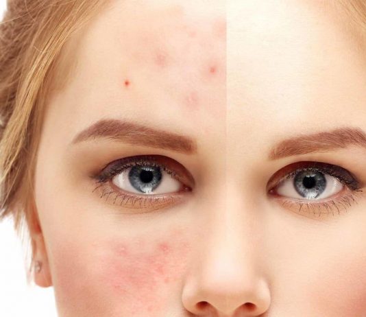 Угревая болезнь – как бороться