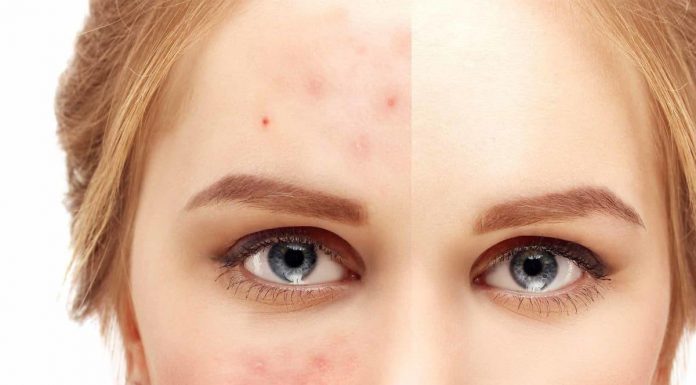 Угревая болезнь – как бороться
