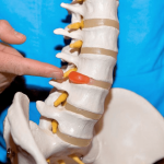 Межпозвоночная грыжа: методы лечения