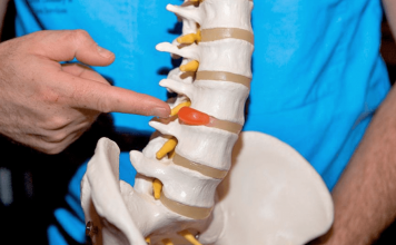 Межпозвоночная грыжа: методы лечения