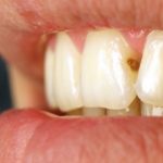 Как убрать кариес на зубах?