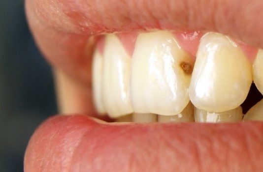 Как убрать кариес на зубах?
