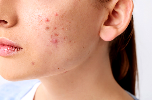 Причины появления акне и современные методы лечения