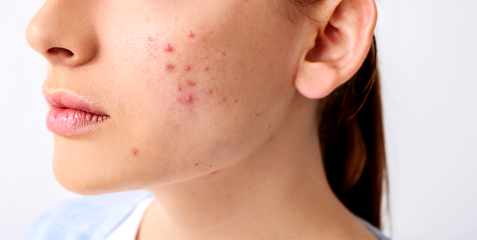 Причины появления акне и современные методы лечения