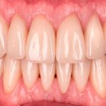 Разрушенный зуб: поэтапный подход к протезированию