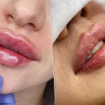 Что нужно знать, если ты решила увеличить губы?