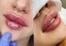 Что нужно знать, если ты решила увеличить губы?