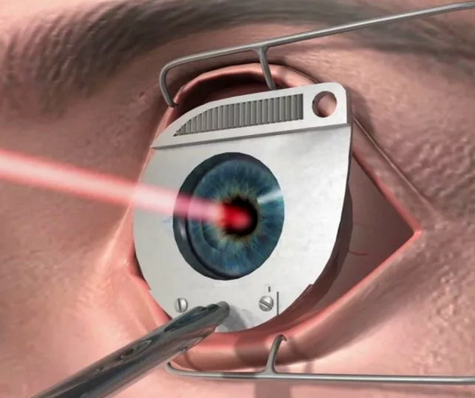 Лазерная коррекция зрения: показания и методы лечения