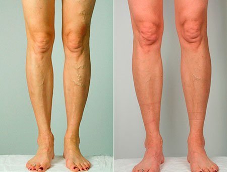 Лечение варикозной болезни с помощью лазера