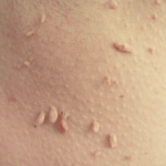 Насколько безопасно удалять папилломы и бородавки?