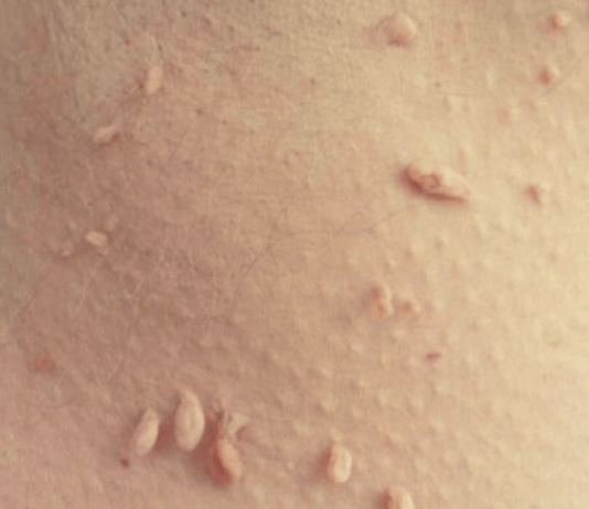 Насколько безопасно удалять папилломы и бородавки?