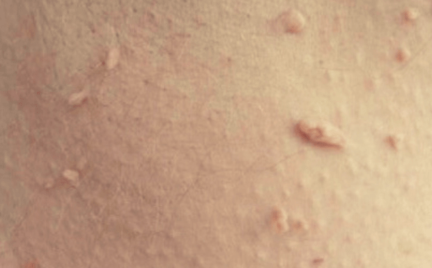 Насколько безопасно удалять папилломы и бородавки?