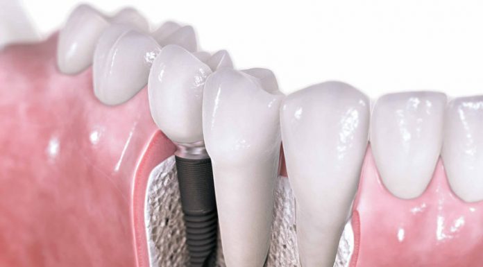 Операция по имплантации зубов: современные подходы