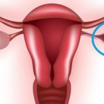 Опасна ли функциональная киста яичника?