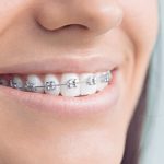 Металлические брекеты: показания и нюансы