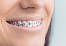 Металлические брекеты: показания и нюансы