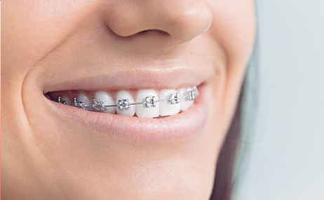 Металлические брекеты: показания и нюансы