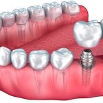 Протезирование зубов: виды, сроки, рекомендации