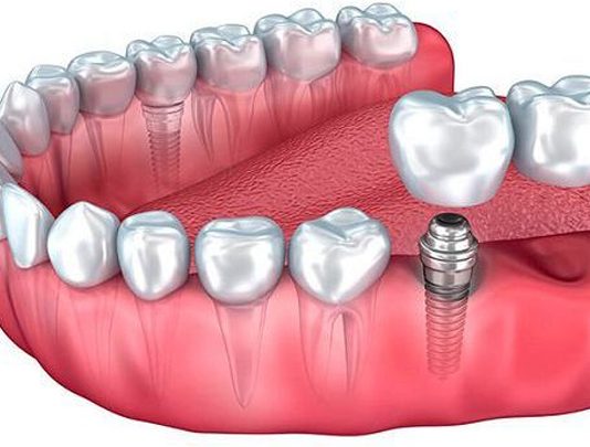 Протезирование зубов: виды, сроки, рекомендации