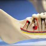 Что такое гемисекция зуба и кому она показана