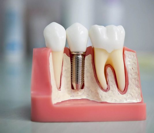 Протезирование зубов: цены, виды протезирования зубов, материалы