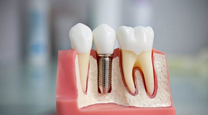 Протезирование зубов: цены, виды протезирования зубов, материалы