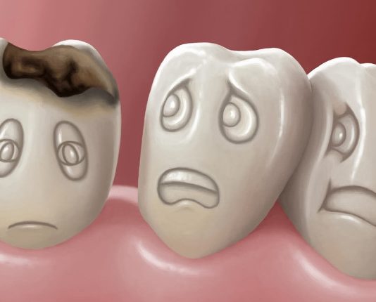 Нужно ли лечить даже очень маленький кариес?