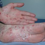 Сифилис: как его распознать и каковы последствия болезни