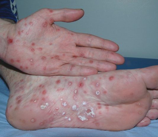 Сифилис: как его распознать и каковы последствия болезни