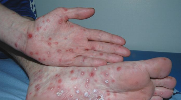 Сифилис: как его распознать и каковы последствия болезни