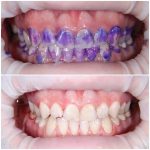 Для чего нужен индикатор зубного налета?