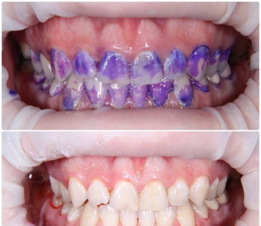 Для чего нужен индикатор зубного налета?