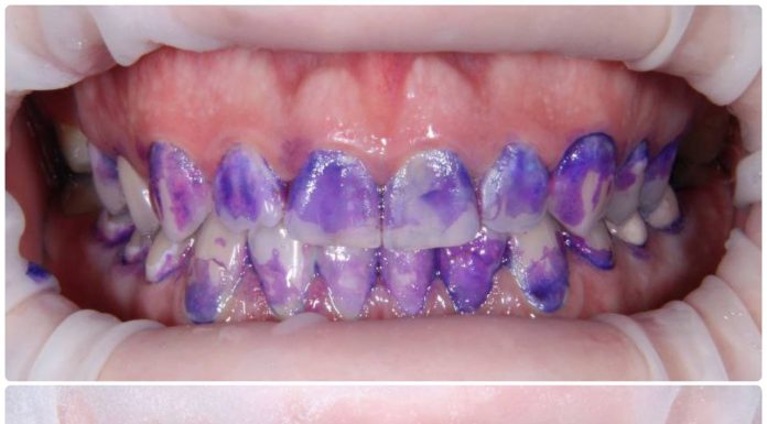 Для чего нужен индикатор зубного налета?