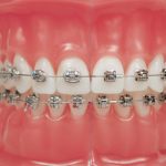 Какие бывают виды брекетов и в пользу каких сделать выбор?